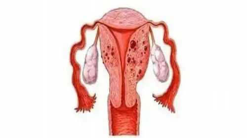 广州试管代孕成功|子宫内膜薄做试管婴儿移植前做宫腔灌注的利弊谁更大？