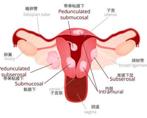 广州代怀医院安全吗,试管婴儿的寿命-深圳哪里可以做供卵-子宫腺肌症和子宫肌