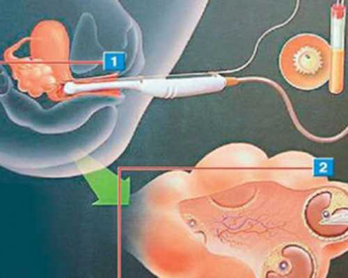 广州地下供卵骗局有哪些,广州供卵试管受骗经历_做代孕公司